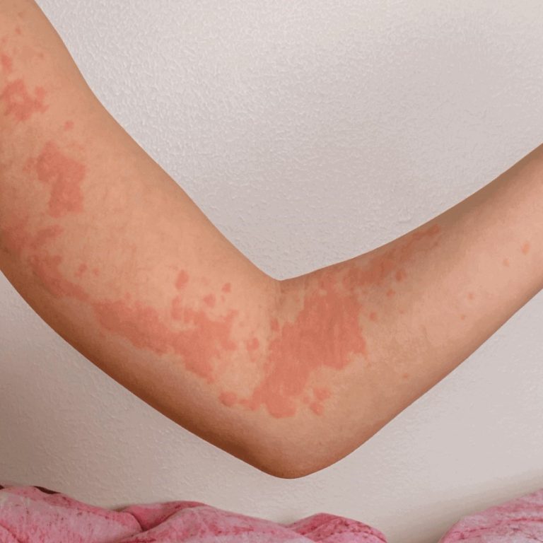 girl-with-urticaria-1536x886