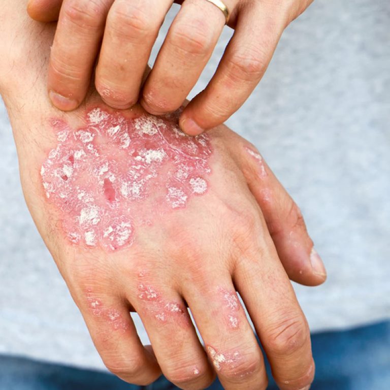 psoriasis-on-hand
