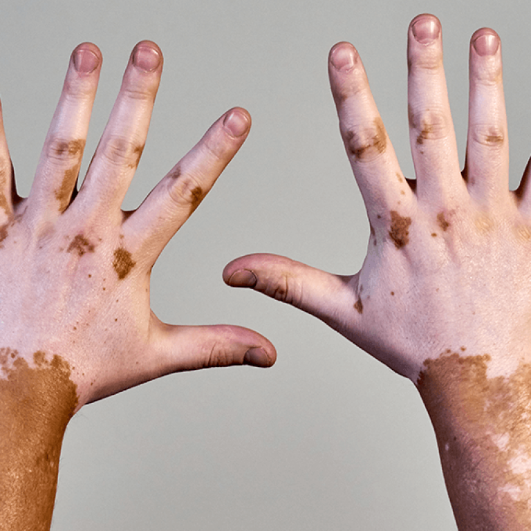 vitiligo (1)